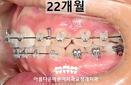 수술후