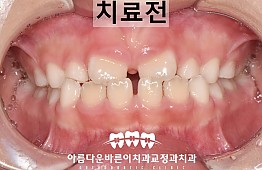 수술전