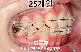 수술후