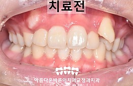 수술전