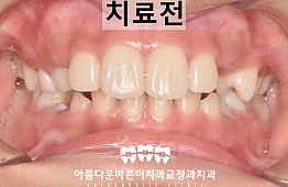 수술전