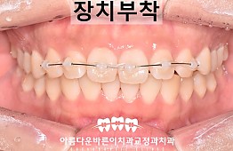 수술후