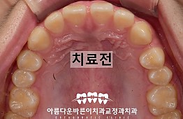 수술전