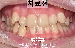 수술전