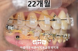 수술후