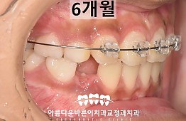 수술후