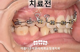 수술전
