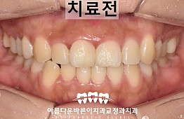 수술전