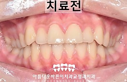 수술전