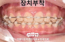 수술후