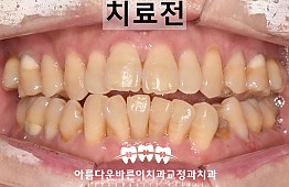 수술전