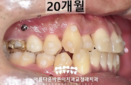 수술후