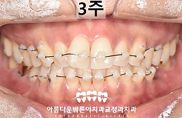 수술후