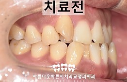 수술전