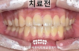 수술전