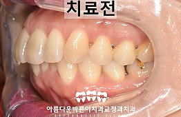 수술전