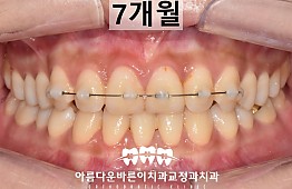 수술후