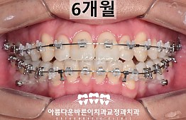 수술후