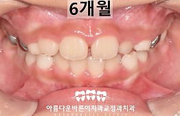 수술후