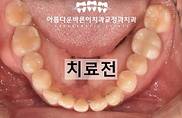 수술전