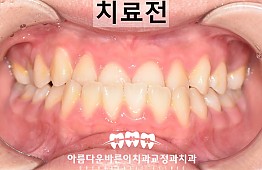 수술전