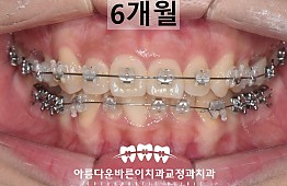 수술후