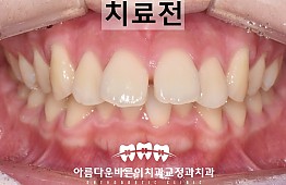 수술전