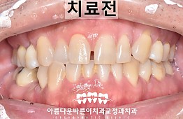 수술전