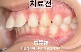 수술전