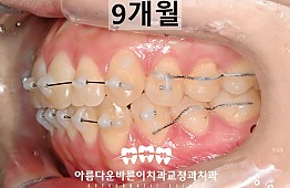 수술후