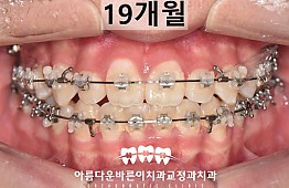 수술후