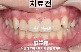 수술전