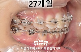 수술후