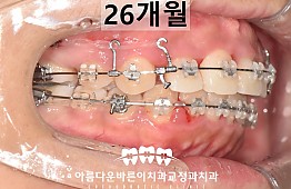 수술후