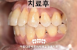 수술후