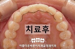 수술후