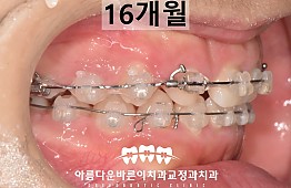 수술후