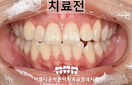 수술전