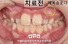 수술전