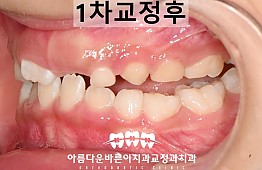 수술후
