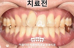 수술전