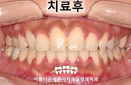 수술후