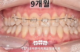 수술후