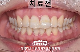 수술전