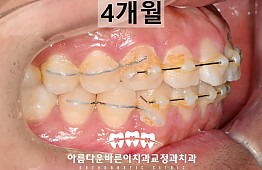 수술후