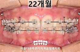 수술후