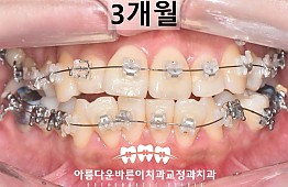 수술후