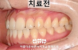 수술전