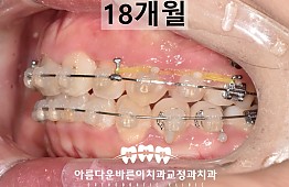 수술후