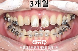 수술후